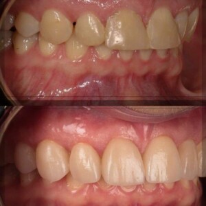 Monolithic Zirconia Crowns