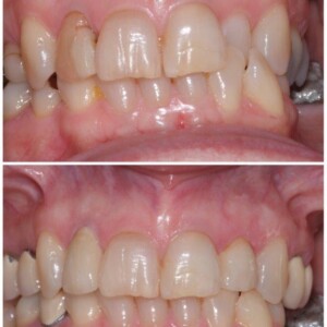 Zirconia Crowns – Multilayer
