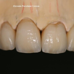 Zirconia Porcelain Crown Multilayer