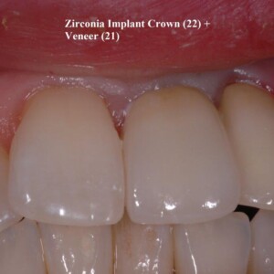 Implant Crown