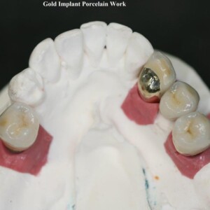 Gold Implant Porcelain Work