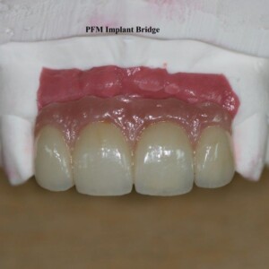 PFM Implant Bridge